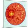 Artwork of Diabetic Retinopathy Ophthalmoscope View-John Bavosi-Mounted Photographic Print