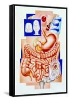 Artwork of Human Intestines And Colostomy-John Bavosi-Framed Stretched Canvas