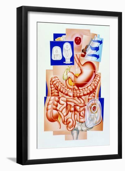 Artwork of Human Intestines And Colostomy-John Bavosi-Framed Photographic Print