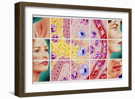 Artwork Showing Acne And Rupture of Follicle-John Bavosi-Framed Photographic Print