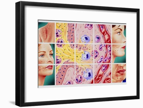 Artwork Showing Acne And Rupture of Follicle-John Bavosi-Framed Photographic Print