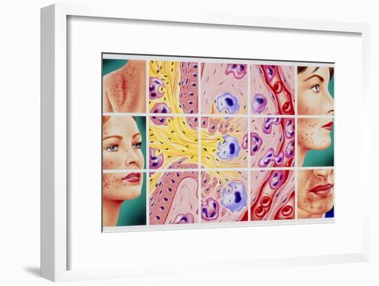 Artwork Showing Acne And Rupture of Follicle-John Bavosi-Framed Photographic Print