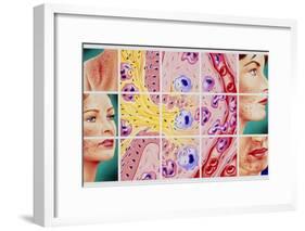 Artwork Showing Acne And Rupture of Follicle-John Bavosi-Framed Photographic Print