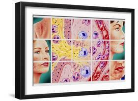 Artwork Showing Acne And Rupture of Follicle-John Bavosi-Framed Photographic Print