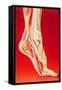 Artwork Showing Calcaneal Spur And Foot Pain-John Bavosi-Framed Stretched Canvas