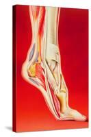 Artwork Showing Calcaneal Spur And Foot Pain-John Bavosi-Stretched Canvas