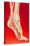 Artwork Showing Calcaneal Spur And Foot Pain-John Bavosi-Stretched Canvas