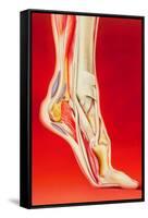 Artwork Showing Calcaneal Spur And Foot Pain-John Bavosi-Framed Stretched Canvas