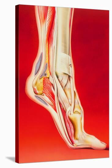 Artwork Showing Calcaneal Spur And Foot Pain-John Bavosi-Stretched Canvas