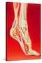 Artwork Showing Calcaneal Spur And Foot Pain-John Bavosi-Stretched Canvas