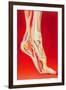 Artwork Showing Calcaneal Spur And Foot Pain-John Bavosi-Framed Photographic Print