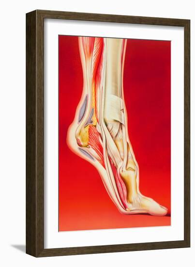 Artwork Showing Calcaneal Spur And Foot Pain-John Bavosi-Framed Photographic Print