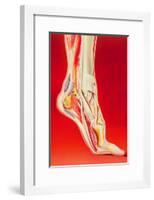 Artwork Showing Calcaneal Spur And Foot Pain-John Bavosi-Framed Photographic Print