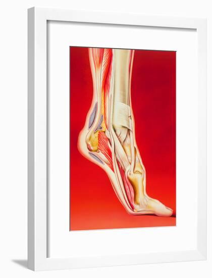 Artwork Showing Calcaneal Spur And Foot Pain-John Bavosi-Framed Photographic Print