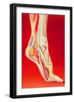 Artwork Showing Calcaneal Spur And Foot Pain-John Bavosi-Framed Photographic Print