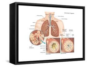 Asthma Attack-Encyclopaedia Britannica-Framed Stretched Canvas