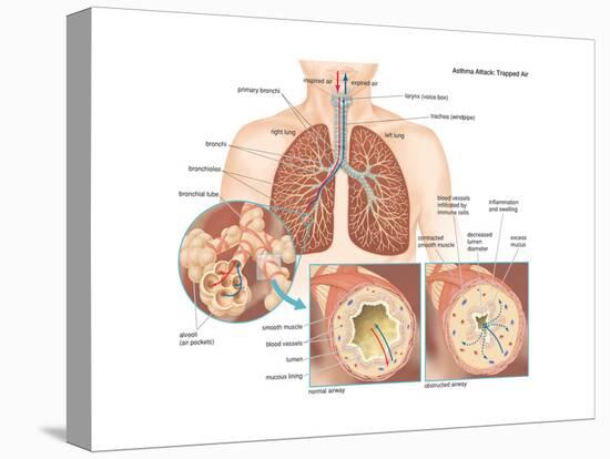 Asthma Attack-Encyclopaedia Britannica-Stretched Canvas