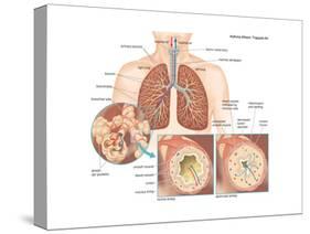 Asthma Attack-Encyclopaedia Britannica-Stretched Canvas