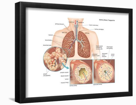 Asthma Attack-Encyclopaedia Britannica-Framed Poster