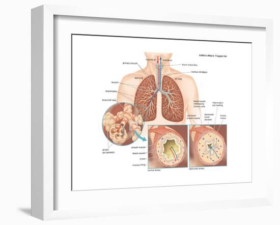 Asthma Attack-Encyclopaedia Britannica-Framed Art Print