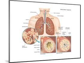 Asthma Attack-Encyclopaedia Britannica-Mounted Art Print