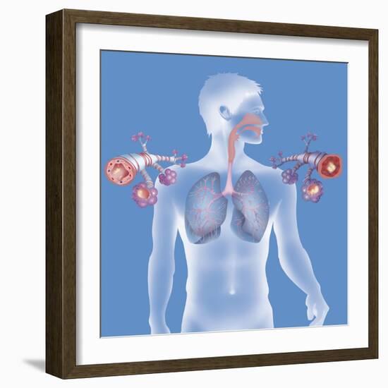 Asthma, Drawing-Caroline Arquevaux-Framed Giclee Print