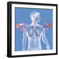 Asthma, Drawing-Caroline Arquevaux-Framed Giclee Print