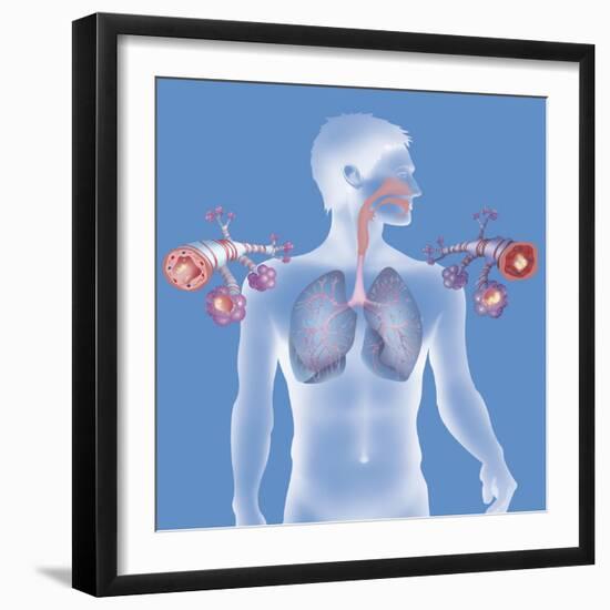 Asthma, Drawing-Caroline Arquevaux-Framed Giclee Print