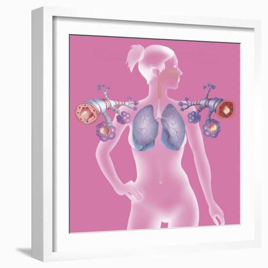 Asthma, Drawing-Caroline Arquevaux-Framed Giclee Print