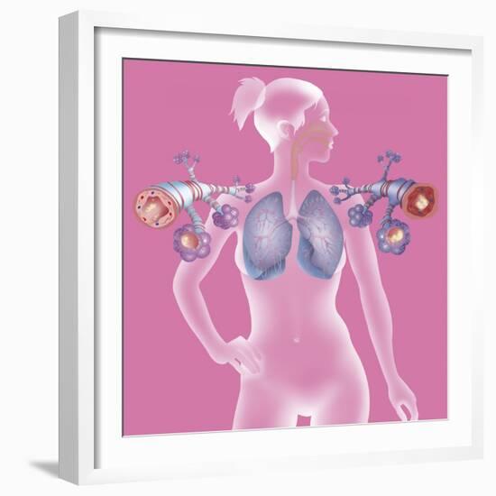 Asthma, Drawing-Caroline Arquevaux-Framed Giclee Print