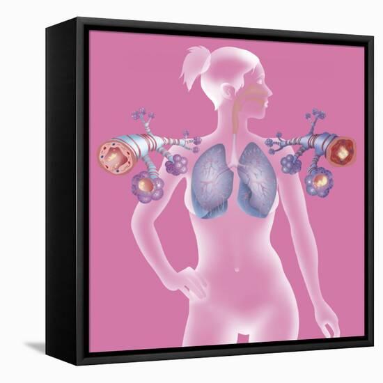 Asthma, Drawing-Caroline Arquevaux-Framed Stretched Canvas