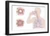 Asthma Pathology And Treatment, Diagram-Peter Gardiner-Framed Photographic Print