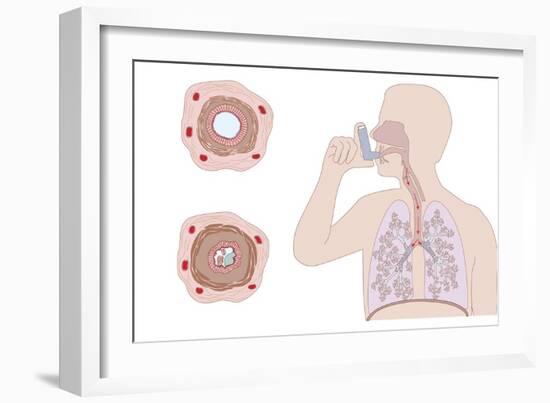 Asthma Pathology And Treatment, Diagram-Peter Gardiner-Framed Photographic Print