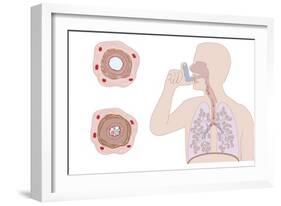 Asthma Pathology And Treatment, Diagram-Peter Gardiner-Framed Photographic Print