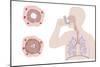 Asthma Pathology And Treatment, Diagram-Peter Gardiner-Mounted Photographic Print