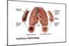 Asthma Pathology-Gwen Shockey-Mounted Premium Giclee Print