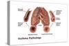 Asthma Pathology-Gwen Shockey-Stretched Canvas