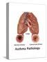 Asthma Pathology-Gwen Shockey-Stretched Canvas