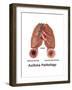 Asthma Pathology-Gwen Shockey-Framed Art Print