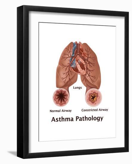 Asthma Pathology-Gwen Shockey-Framed Art Print