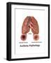 Asthma Pathology-Gwen Shockey-Framed Art Print