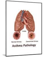 Asthma Pathology-Gwen Shockey-Mounted Art Print