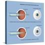 Astigmatism and Correction with Corrective Lens-null-Stretched Canvas