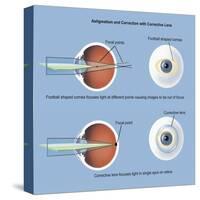 Astigmatism and Correction with Corrective Lens-null-Stretched Canvas