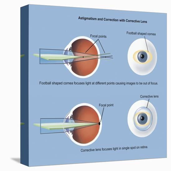 Astigmatism and Correction with Corrective Lens-null-Stretched Canvas