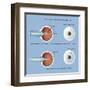 Astigmatism and Correction with Corrective Lens-null-Framed Art Print