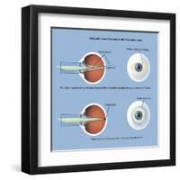 Astigmatism and Correction with Corrective Lens-null-Framed Art Print