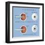 Astigmatism and Correction with Corrective Lens-null-Framed Art Print