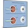 Astigmatism and Correction with Corrective Lens-null-Mounted Art Print