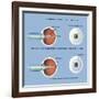 Astigmatism and Correction with Corrective Lens-null-Framed Art Print